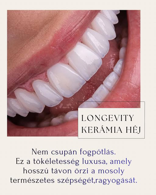 Longevity kerámia héjjal készült természetes, hófehér mosoly – Smileland Dental Kecskemét