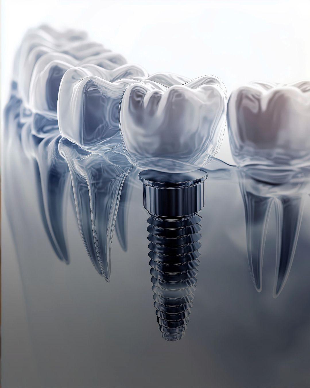 Fogászati implantátumok – fogászati kezelés Kecskeméten